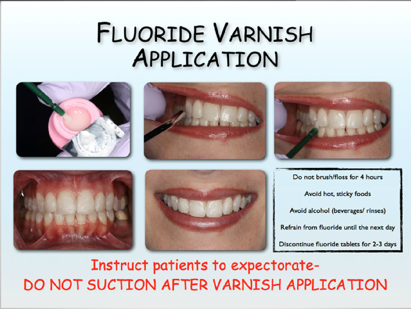 fluoride varnish brands