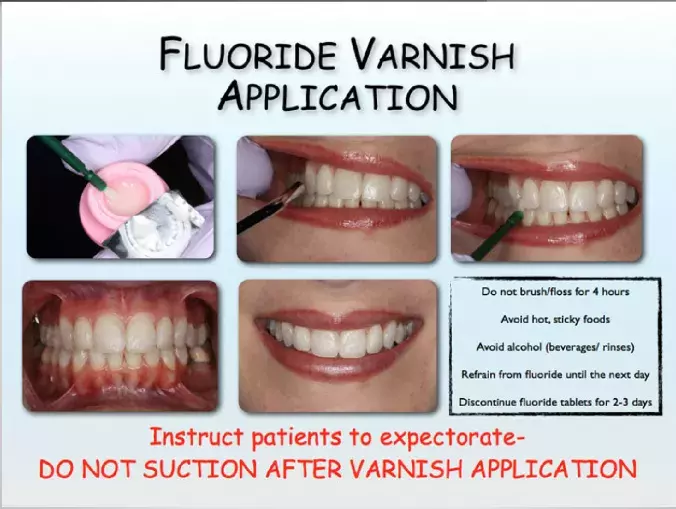 Fluoride Varnish