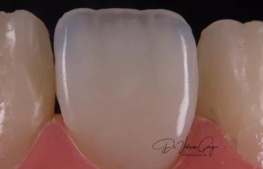 LEVEL 1 - PED: DIRECT NATURAL AESTHETICS - SCULPTING STUNNING SMILE
