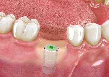 implant inserted