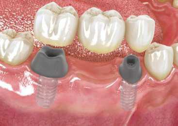 Mise en place des piliers sur les implants