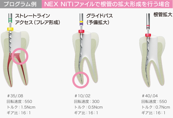 NiTi ファイル ニッケルチタン www.seven-health.com