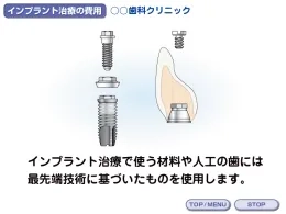 デンタルIQさん「インプラント編」