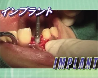 確実なインプラント治療とは −患者さんへの適切な情報提供と確実な欠損補綴治療の実際−